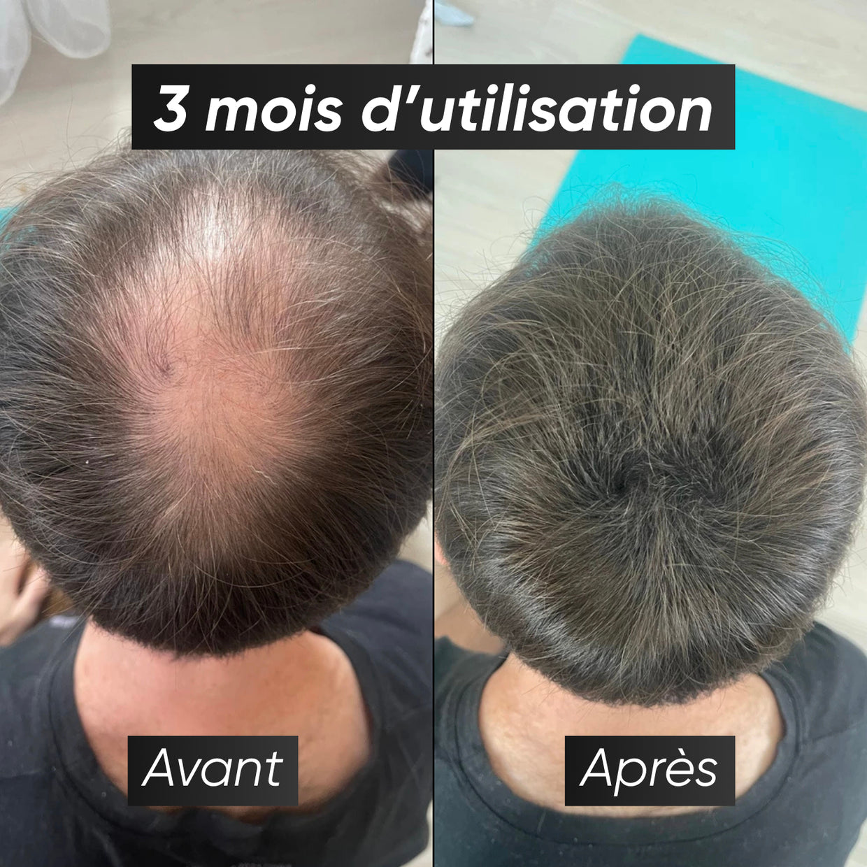Sérum repousse et anti chute de cheveux